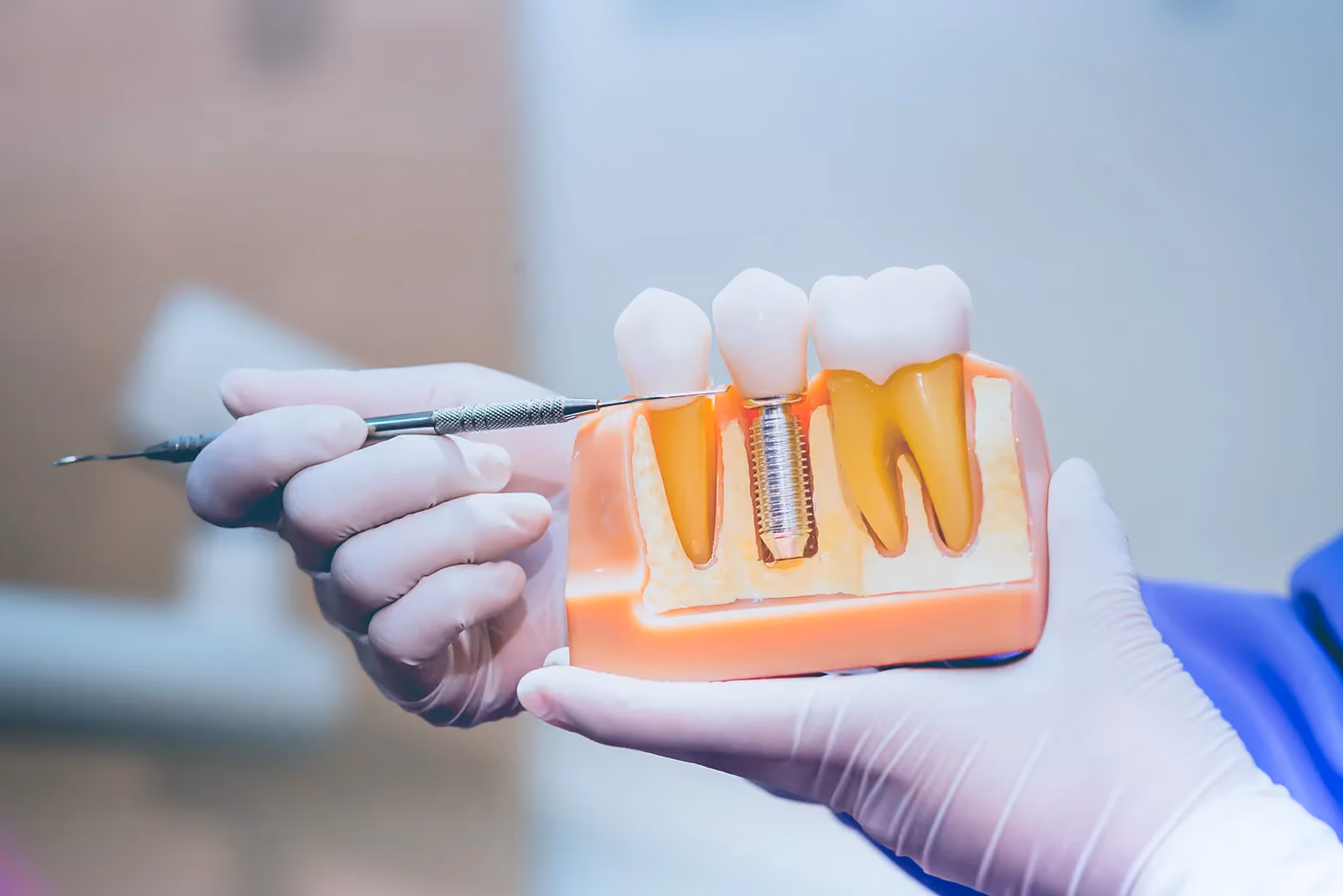 Why Are These the Dental Implants Freehold Loves?