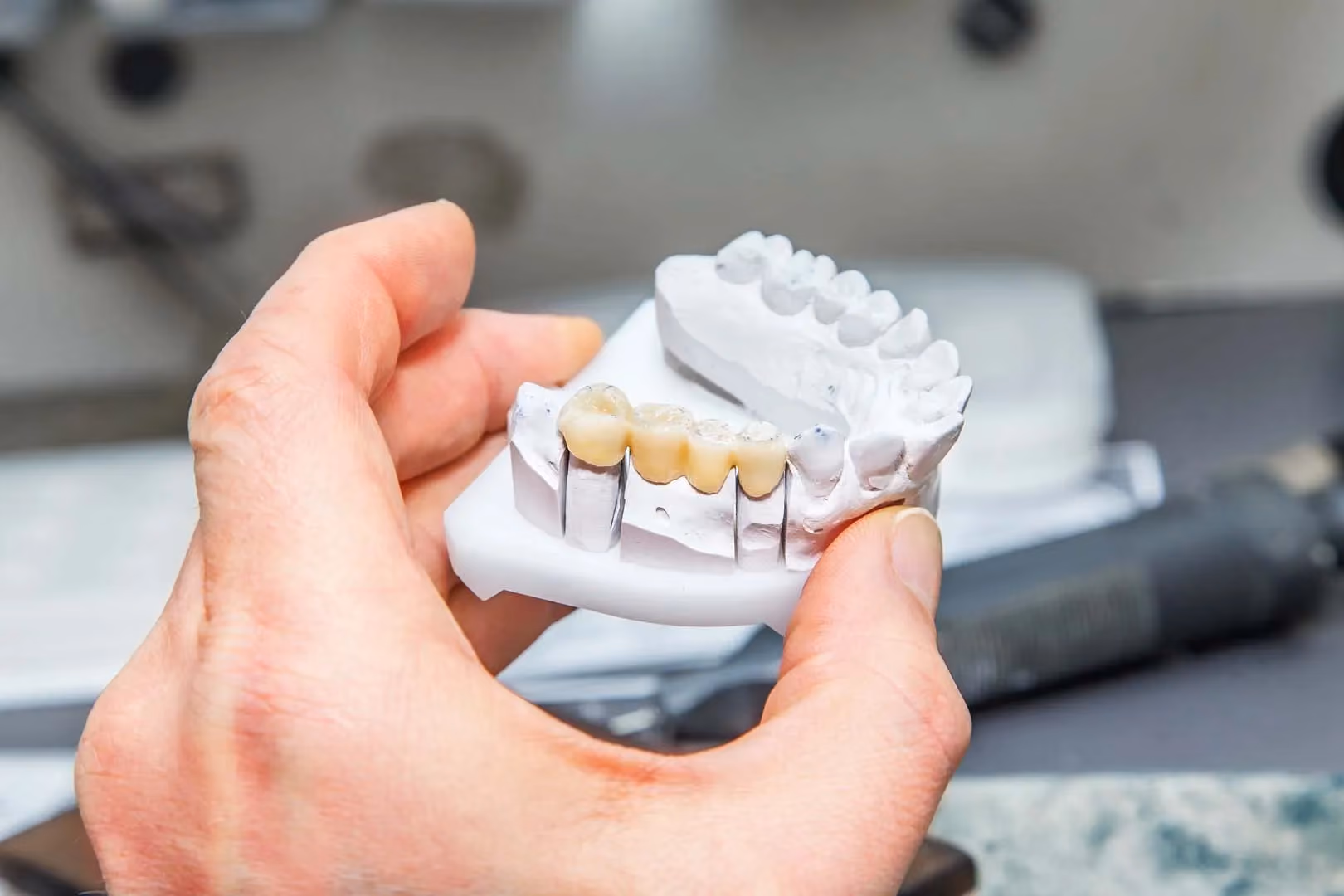 When Would the Manalapan Dentist Recommend a Bridge?