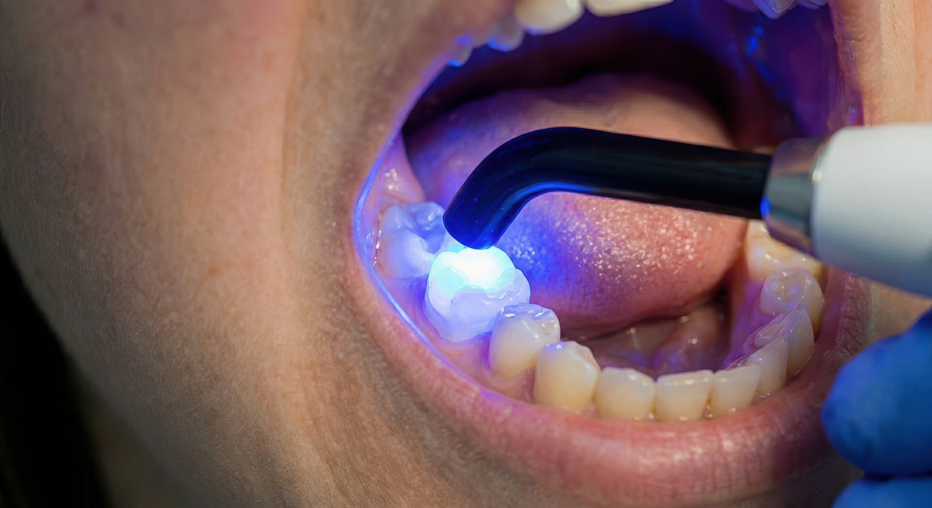 Dental Fillings: Signs You Might Need One (And What to Expect)