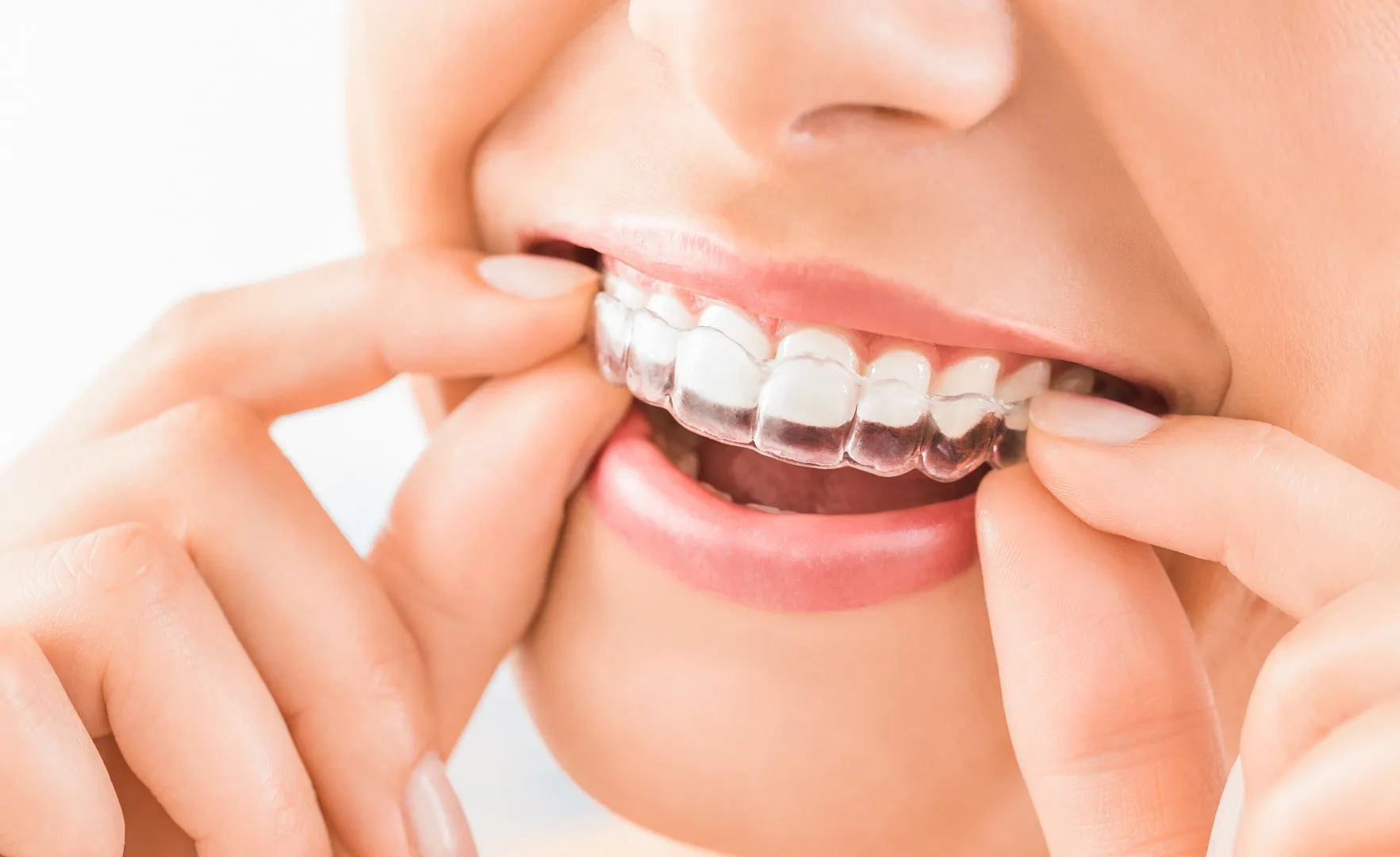 Invisalign vs. Braces: How to Choose the Right Option in Freehold, NJ