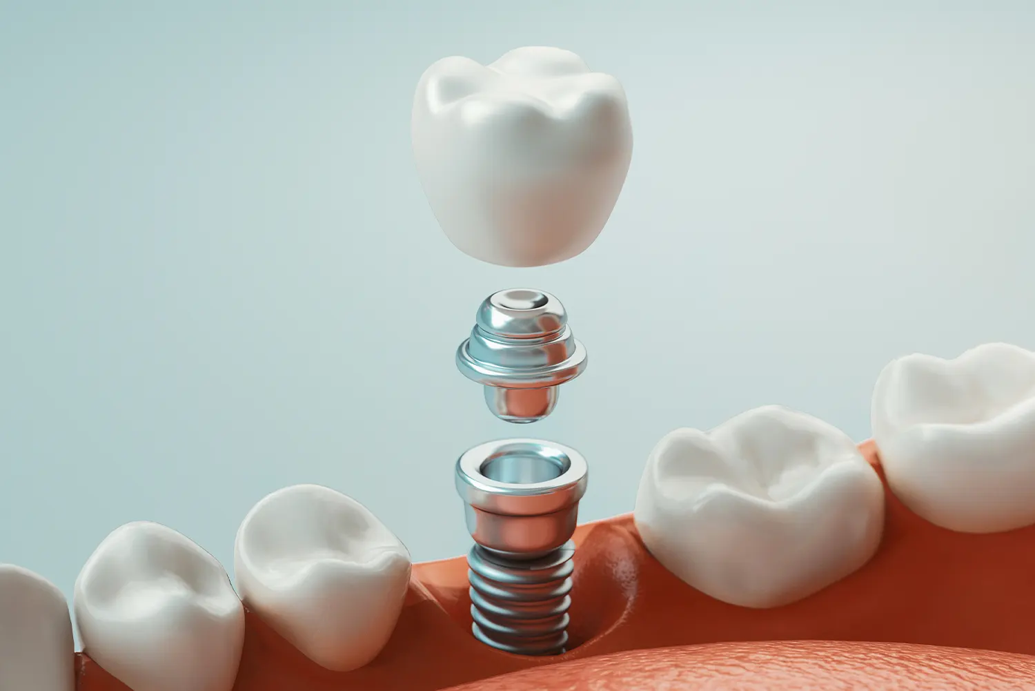 Premier Arts Dental - dental implants